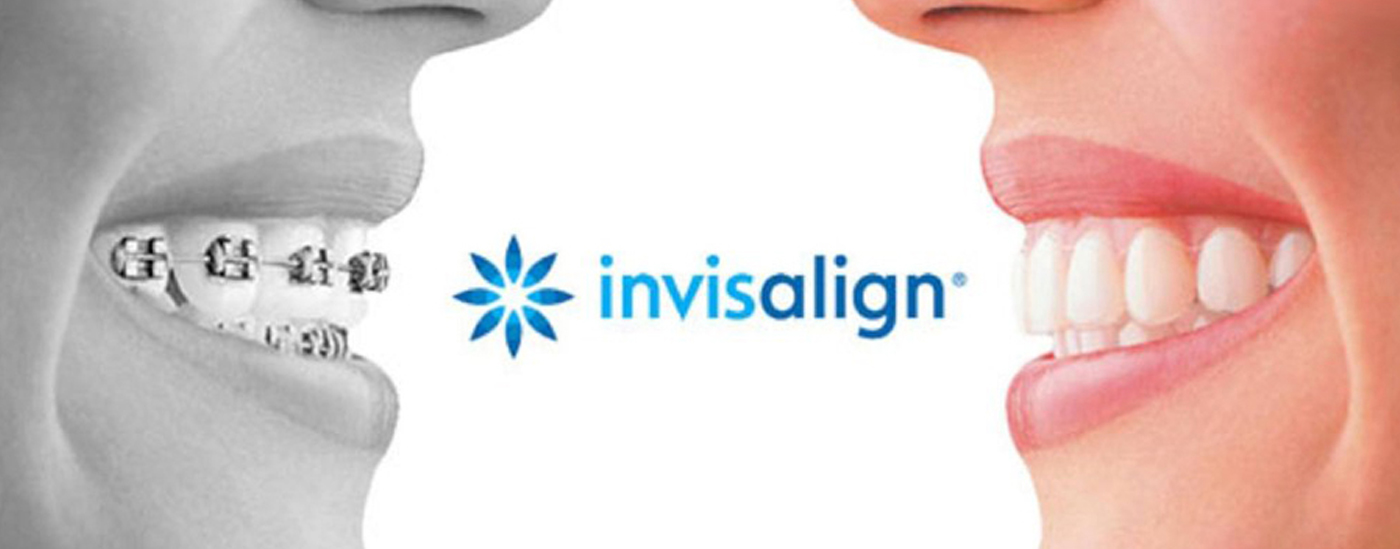 Invisalign Clear Braces Tustin, Irvine, Costa Mesa, Newport Beach