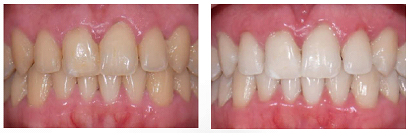 Teeth Whitening - Before & After
